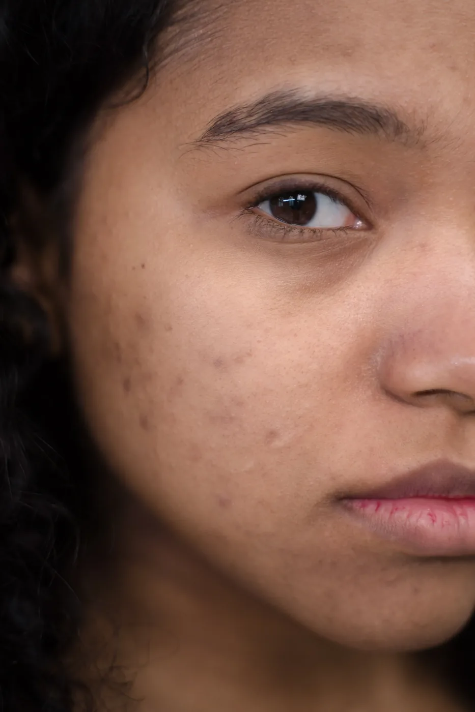 Close-up of a cheek with acne before treatment.